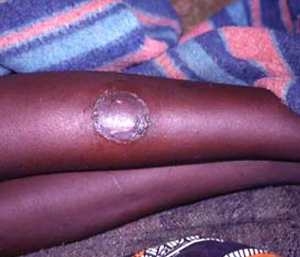 African-Trypanosomiasis