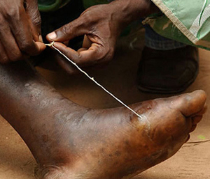Guinea-Worm-Disease