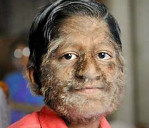 Hypertrichosis-Werewolf-Syndrome