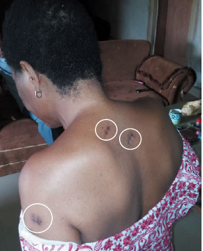 Scars-from-stabbing-on-Mrs.-Ashinwo’s-back